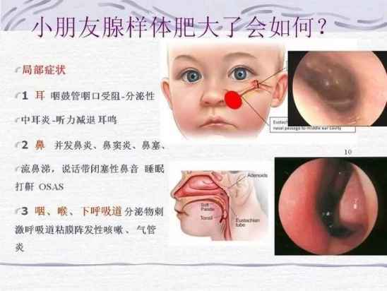 国内试管婴儿宝宝为什么会打呼噜